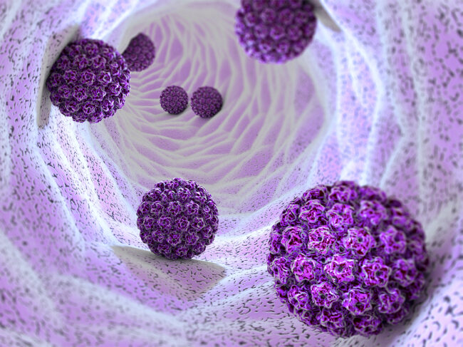 Illustration of human papillomavirus infection